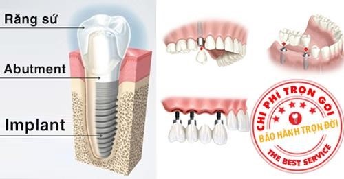 cấu tạo răng giả implant