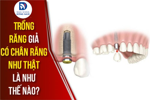 phương pháp trồng răng giả có chân răng như thật là như thế nào
