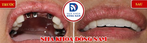 trồng răng giả có chân răng bằng implant