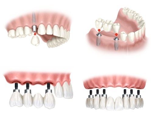 phương pháp trồng răng giả có chân răng