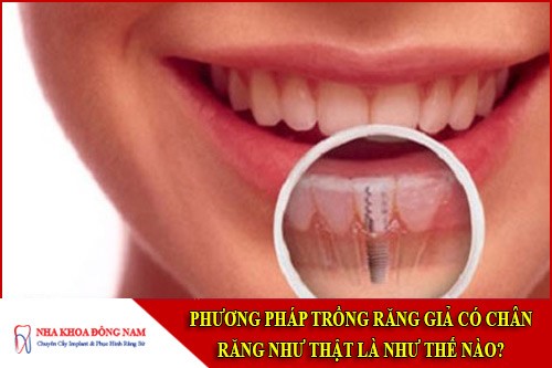 phương pháp trồng răng giả có chân răng như thật là như thế nào