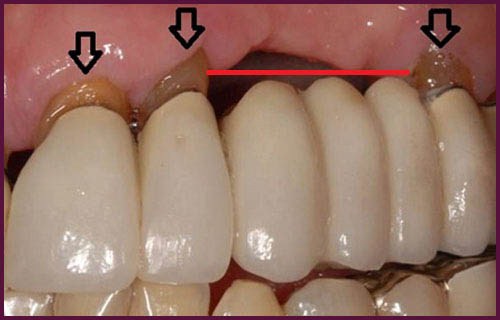 phương pháp trồng răng sứ là như thế nào 5