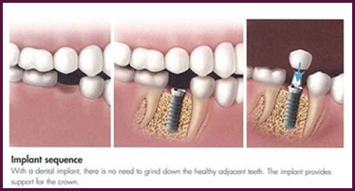 phương pháp trồng răng sứ là như thế nào 6