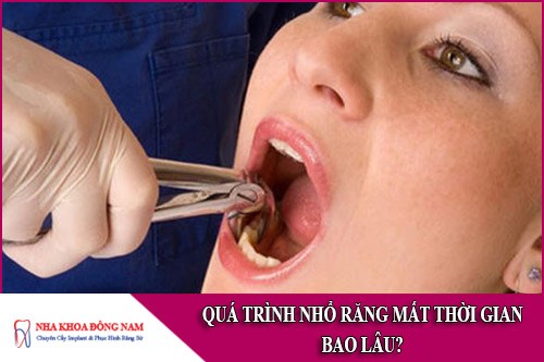 quá trình nhổ răng mất thời gian bao lâu