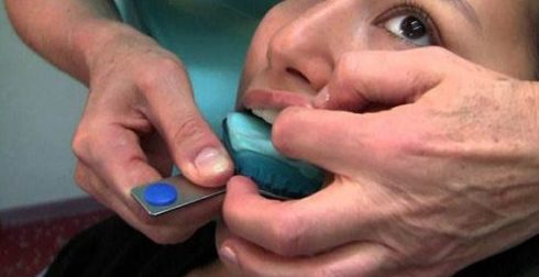 quy trình làm răng giả tháo lắp tại nha khoa Đông Nam 3