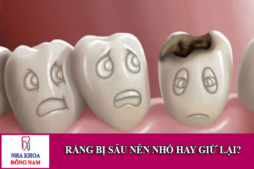 răng bị sâu nên nhổ hay giữ lại