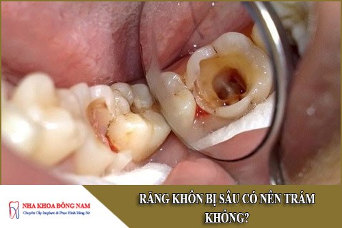 răng khôn bị sâu có nên trám không