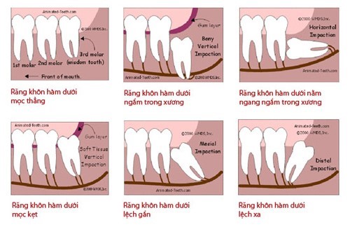 răng khôn bị sâu có nên trám không 2