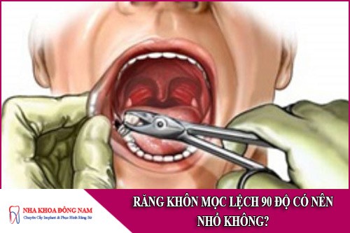 răng khôn mọc lệch 90 độ có nên nhổ không