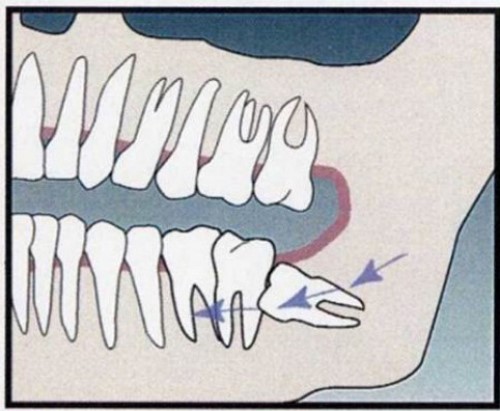 tác hại của răng khôn mọc lệch