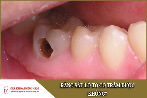 răng sâu lỗ to có trám được không