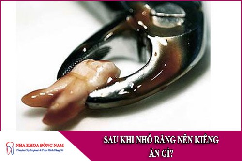 sau khi nhổ răng nên kiêng ăn gì