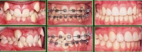 sau khi sinh có niềng răng được không 5