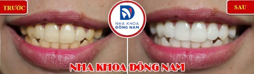 trước và sau khi tẩy trắng răng
