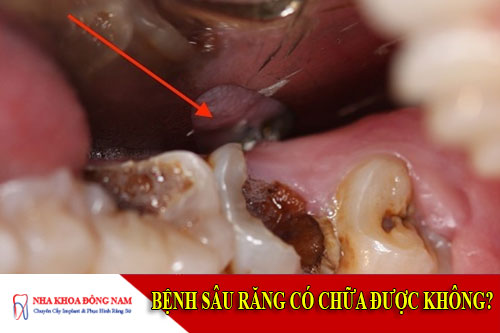 bệnh sâu răng có chữa được không
