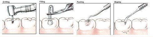 sự thật về con sâu ở trong răng 4