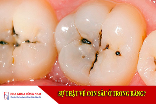 sự thật về con sâu ở trong răng
