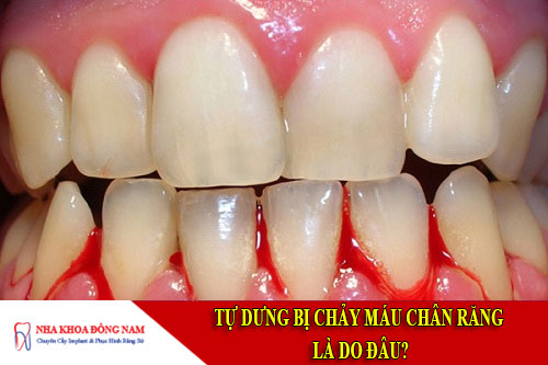 tự dưng bị chảy máu chân răng là do đâu