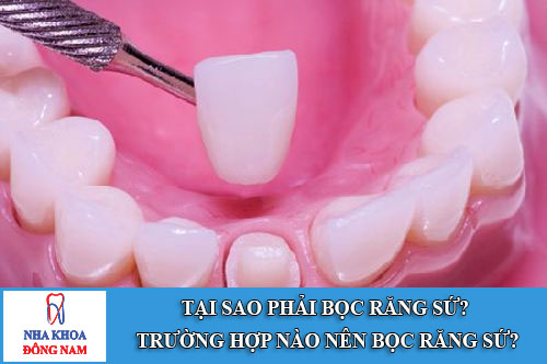 tại sao phải bọc răng sứ? trường hợp nào nên bọc răng sứ