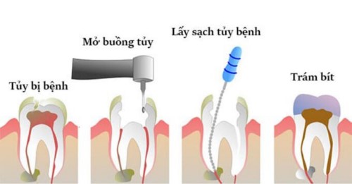 kỹ thuật lấy tủy răng