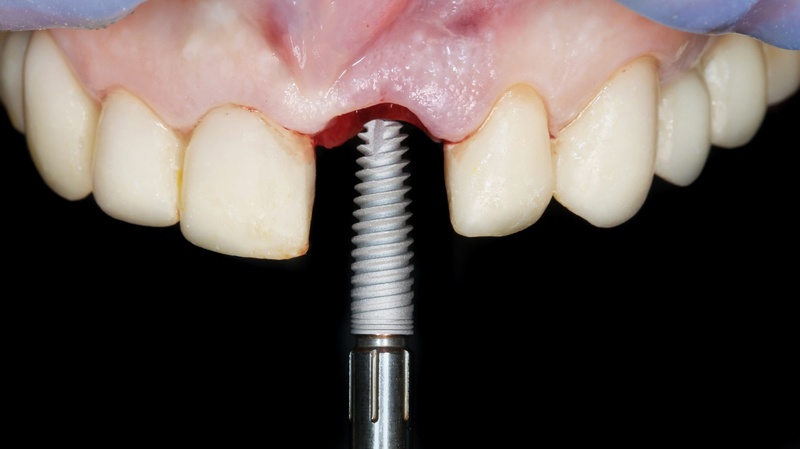 Trồng lại răng Implant mới nếu trụ Implant cũ có dấu hiệu lung lay