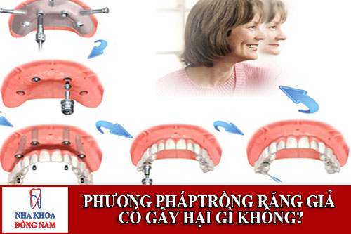 phương pháptrồng răng giả có gây hại gì không