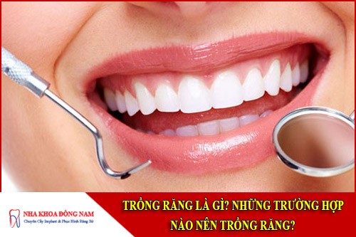 trồng răng là gì? Những trường hợp nào nên trồng răng?