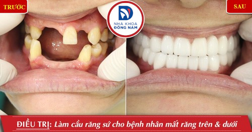 làm cầu răng sứ cho răng hàm trên và dưới