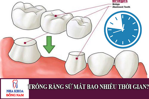 trồng răng sứ mất bao nhiêu thời gian