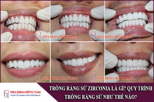 trồng răng sứ zirconia là gì? quy trình trồng răng sứ như thế nào