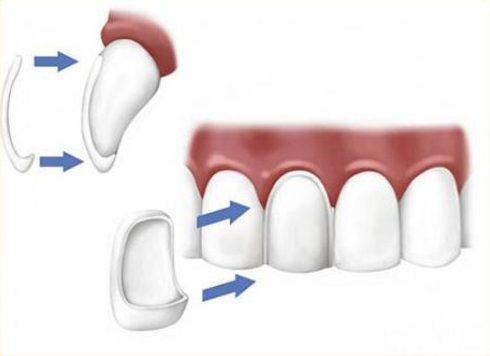 ưu nhược điểm của phương pháp dán răng sứ 2