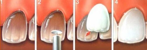 ưu nhược điểm của phương pháp dán răng sứ 3