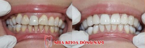 ưu nhược điểm của phương pháp dán răng sứ 4