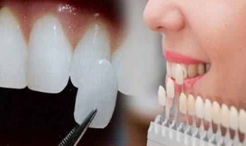 ưu nhược điểm của phương pháp dán răng sứ 7