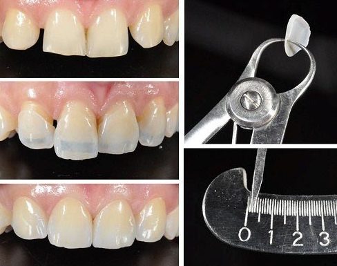 ưu nhược điểm của phương pháp dán răng sứ 9