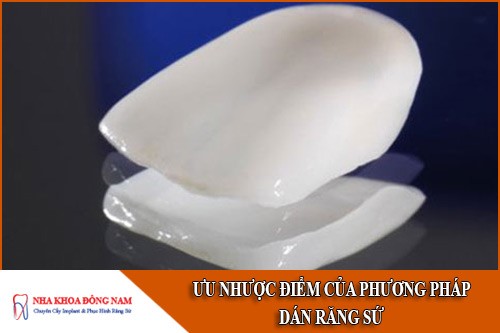 ưu nhược điểm của phương pháp dán răng sứ