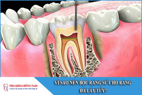 vì sao nên bọc răng sứ cho răng đã lấy tủy