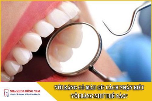 vôi răng có màu gì? cách nhận biết vôi răng như thế nào