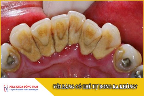 vôi răng có thể tự bong ra không