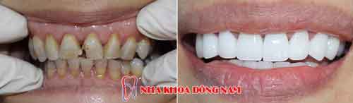 bọc 2 hàm răng sứ hi-zirconia cho răng bị nhiễm tetracycline -18112016