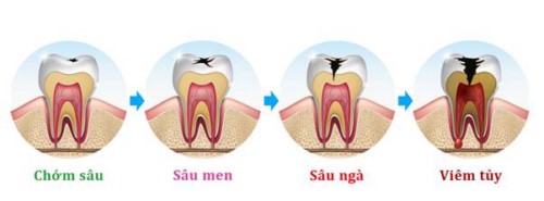các giai đoạn sâu răng