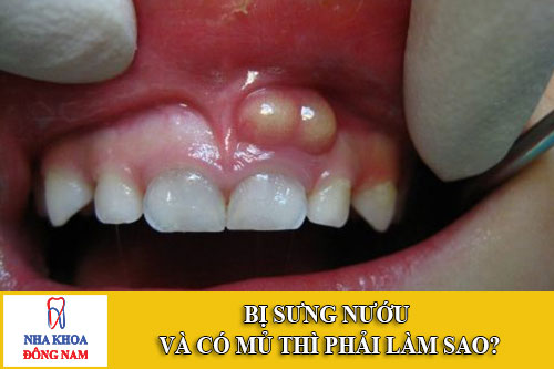 bị sưng nướu và có mủ thì phải làm sao