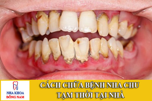 cách chữa bệnh nha chu tạm thời tại nhà