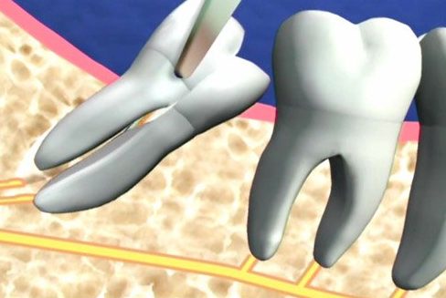 cách xử lý viêm nướu răng khôn khi mang thai 2