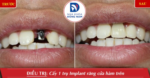cấy ghép implant răng cửa cho bệnh nhân mất răng không thể giữ lại