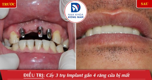 trồng 3 răng cửa bằng implant