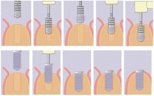 mô phỏng quy trình đặt trụ implant