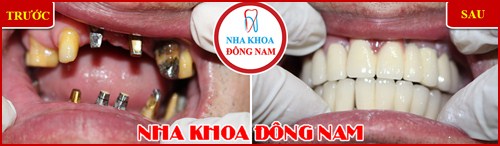 Cấy ghép Implant hàn quốc có tốt không 8