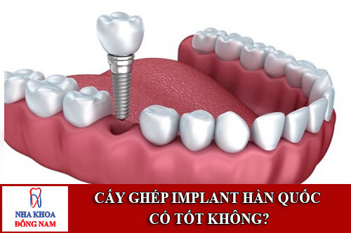 Cấy Ghép Implant Hàn Quốc Có Tốt Không