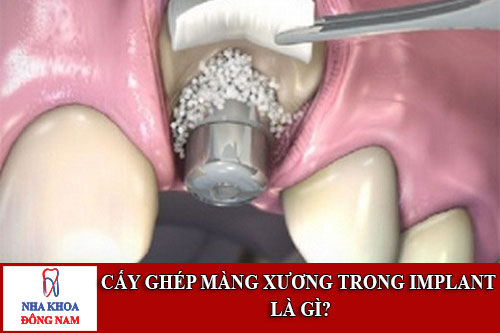 cấy ghép màng xương trong implant là gì
